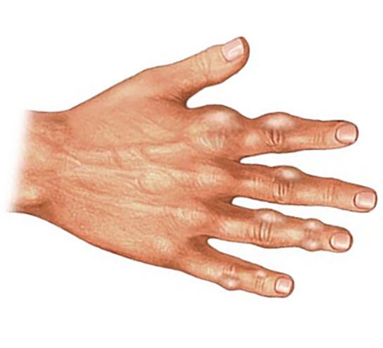 Deposition of uric acid crystals in the soft tissues of the fingers with gouty arthritis
