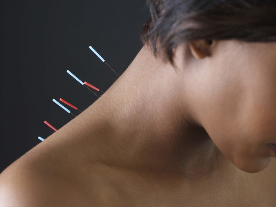 Acupuncture for cervical osteochondrosis eliminates inflammatory processes. 
