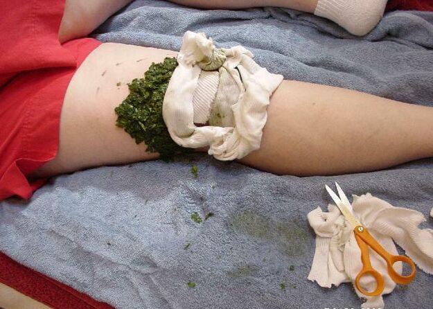 A hot compress of shredded cabbage leaves on a sore knee joint with osteoarthritis