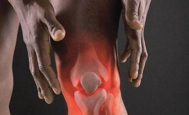 Osteoarthritis is accompanied by an inflammatory process in the knee joint. 